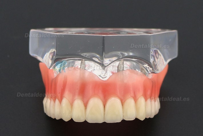 Dental Study Teeth Model Overdenture Superior With 4 Implants Demo Model 6001